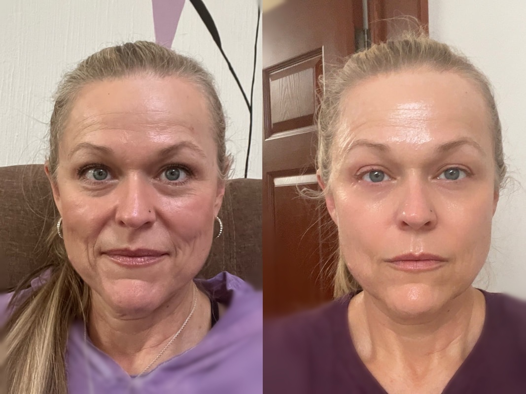 Before and after MuseExosomes treatment, showing skin texture and tone after a series of sessions