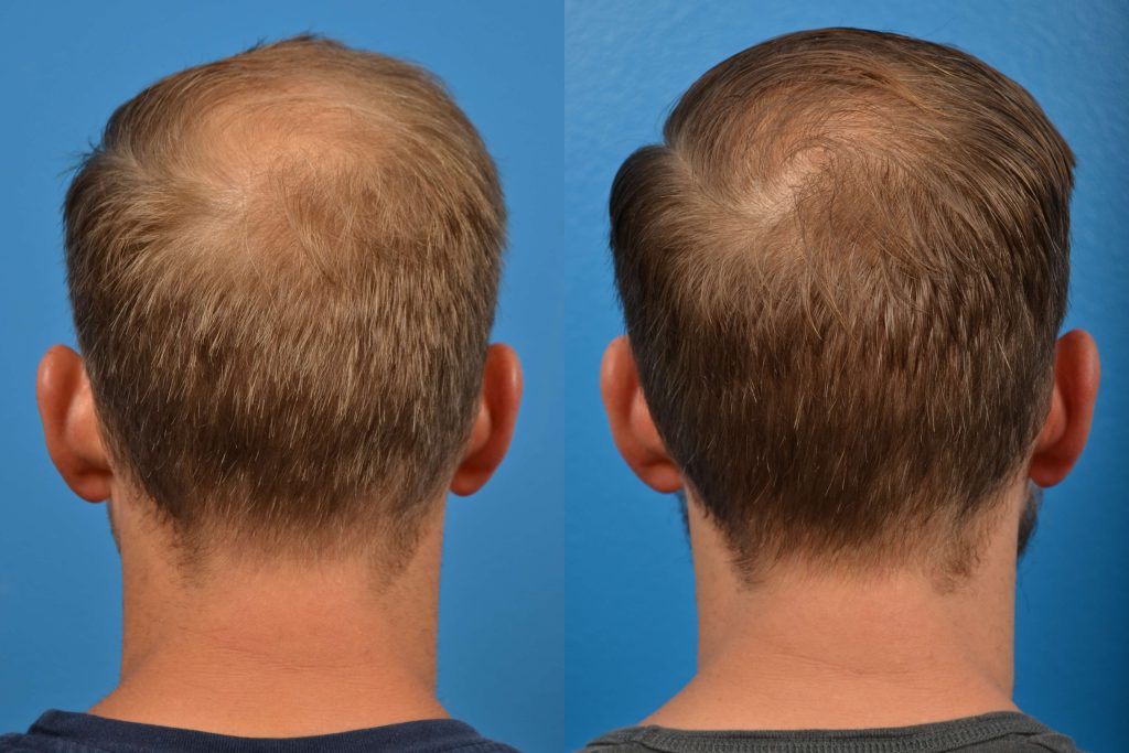 Before and after scalp treatment with MuseExosomes, showing hair density at the crown